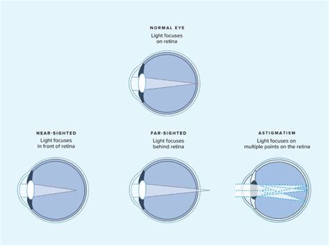 refractometer ey glasses|how to refract ophthalmology.